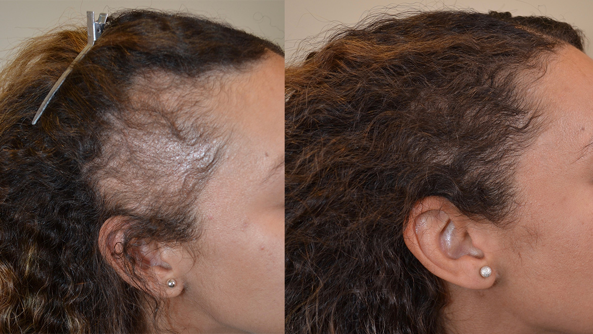 Traction Alopecia (CHT)