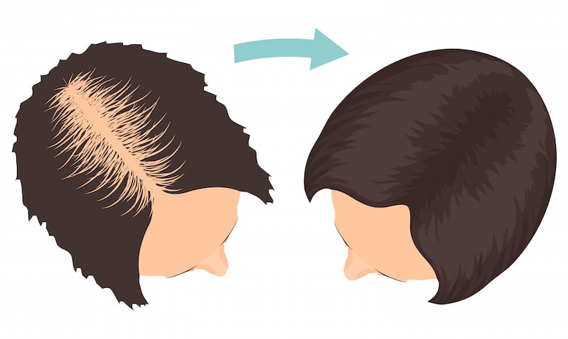 Woman's Hair Transplant (CHT)