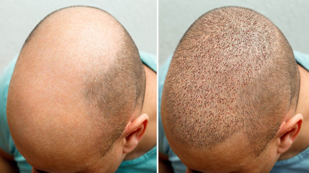 hair-transplant-1200x675.jpg