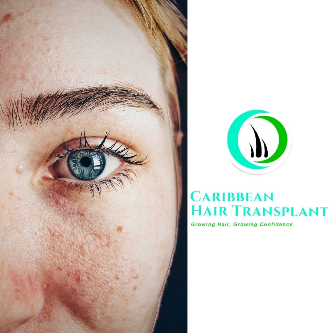 Blog - Caribbean Hair Transplant Centre