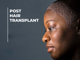 Post Hair Transplant