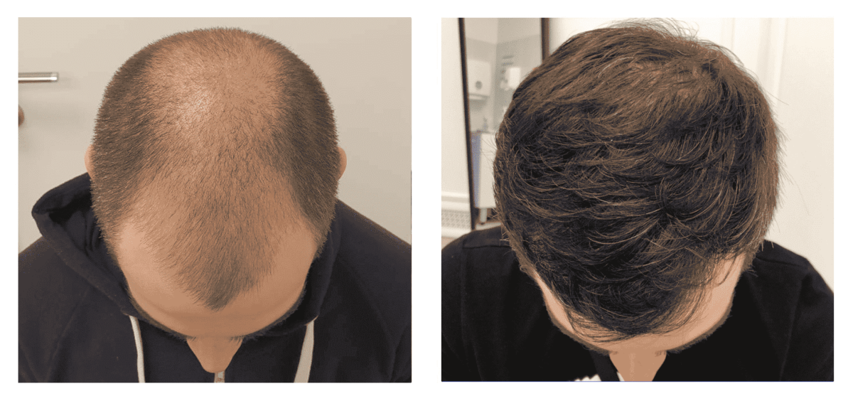 Hair-transplantation-before-and-after-2-1-1200x564.png