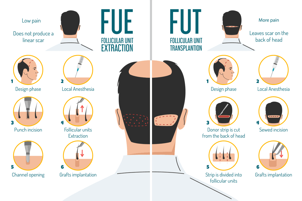 FUE vs. FUT