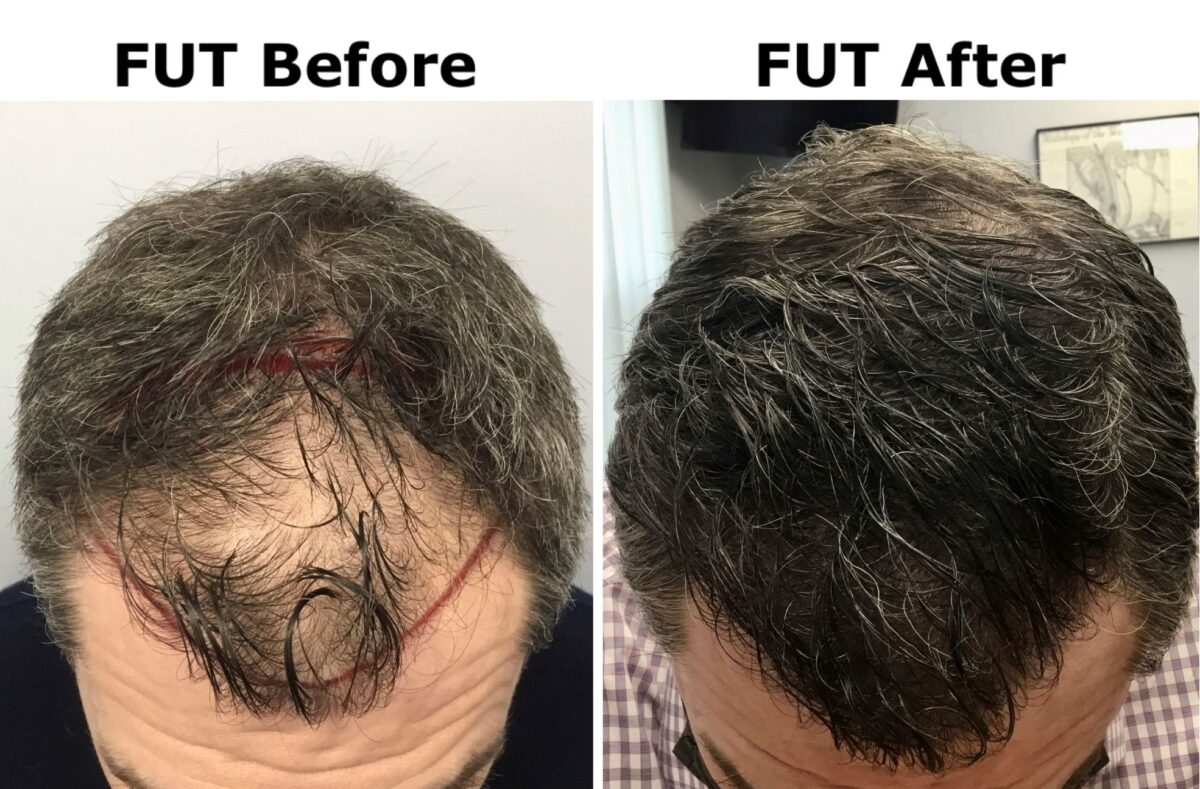 FUT Before and After